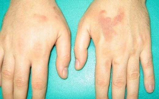 eskuetako artikulazioetan mina parasitoen sintomak izan daitezke