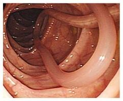 parasitoak giza gorputzean