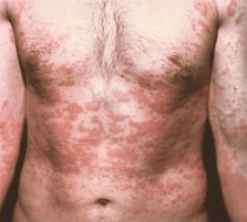 problematikoa azalaren presentzia parasitoen sintoma da